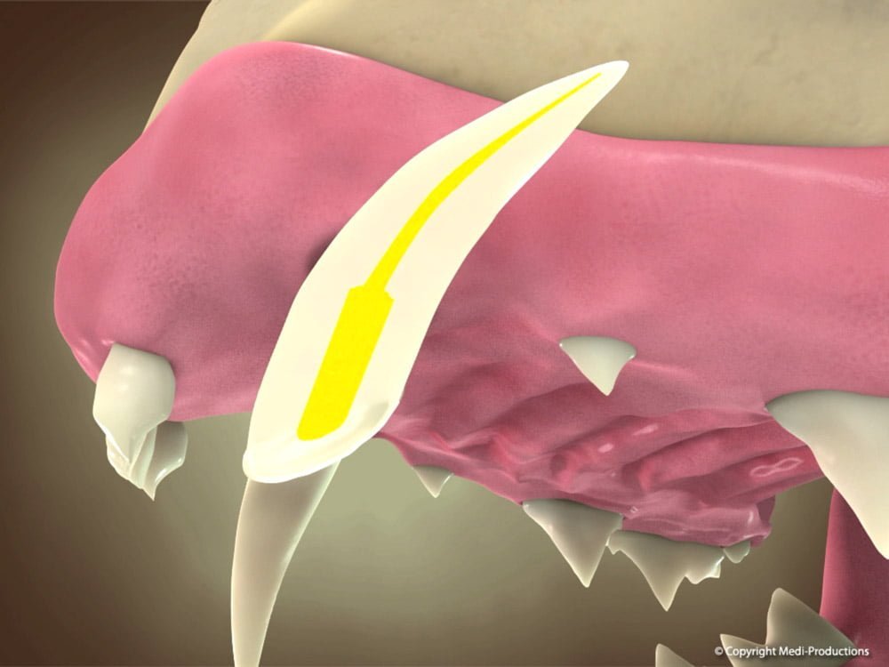 Tratamento de Canal de Dente Preenchimento